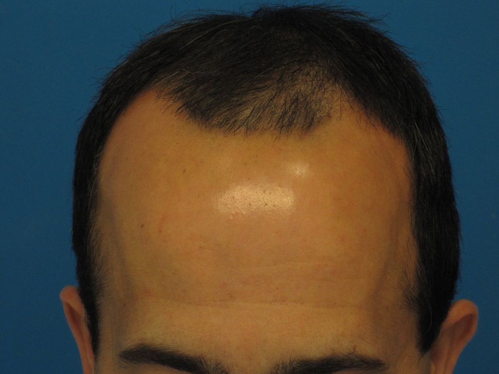 PreOphairline.jpg