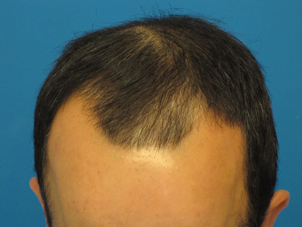 PreOphairline2.jpg