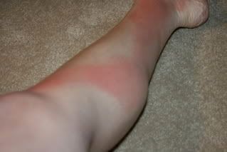 wonky sunburn